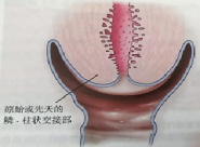 宮頸癌篩查沒那么簡單，這些技巧助你提高取樣質(zhì)量